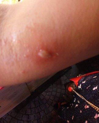 Chữa vết đốt của kiến ba khoang với dầu dừa hoa bưởi vitamin E